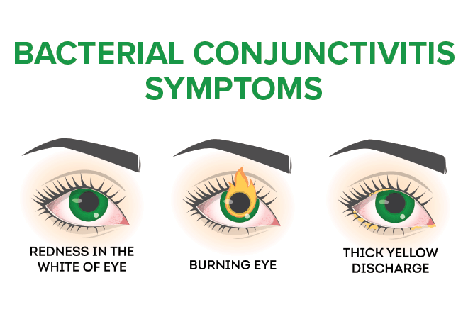 Symptoms of pink eye based on type of conjunctivitis Symptoms of pink eye based on type of conjunctivitis