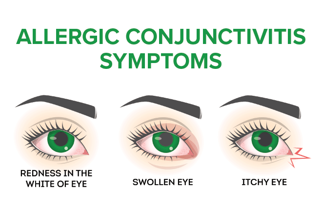 Symptoms of pink eye based on type of conjunctivitis Symptoms of pink eye based on type of conjunctivitis
