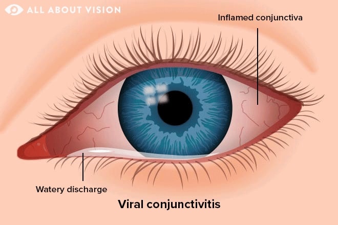 Types of pink eye: Bacterial, viral and allergic conjunctivitis