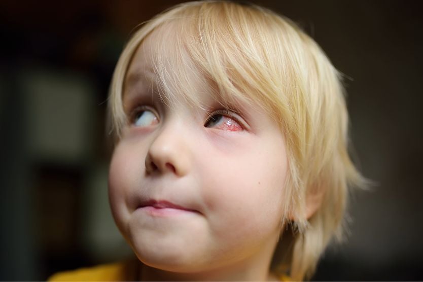 boy with vernal conjunctivitis