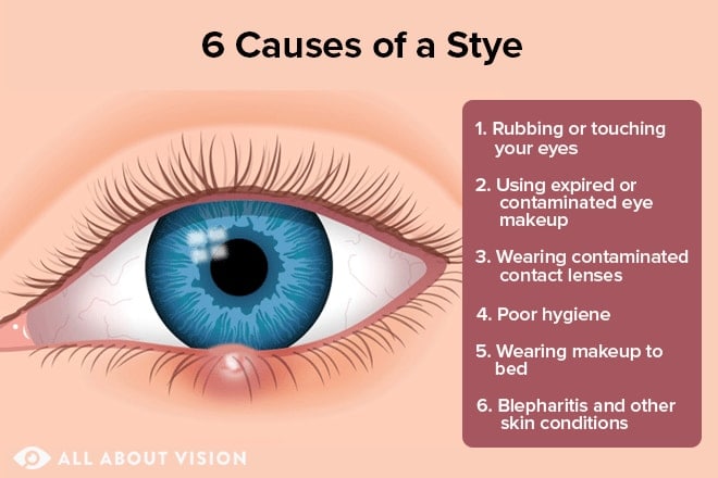 How do you get a stye?