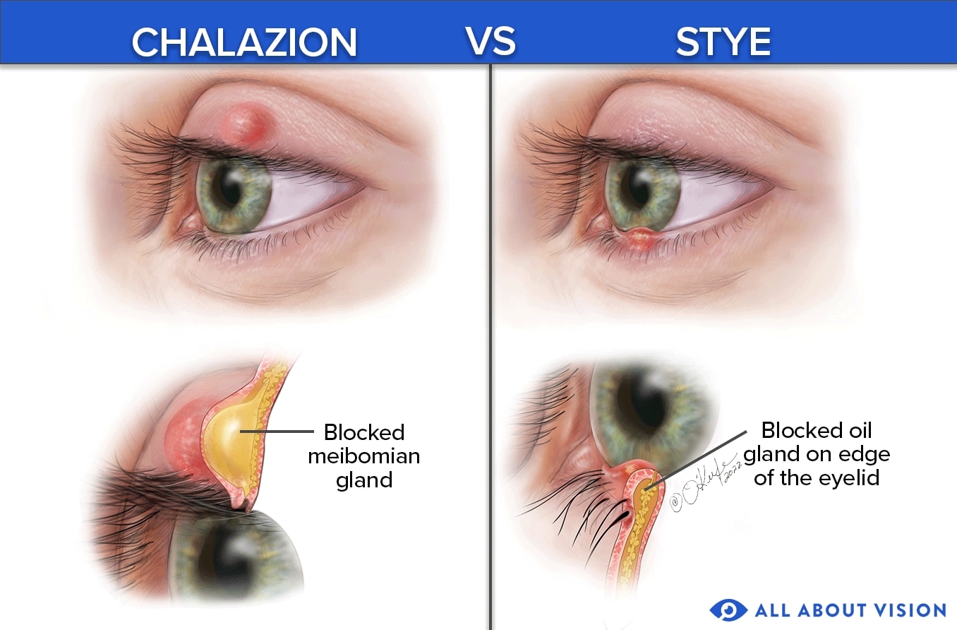 Chalazion: Symptoms, causes, treatment and prevention
