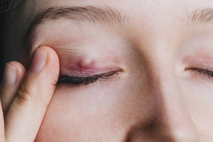 Young girl shows a chalazion on the eyelid closeup.