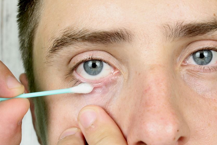 10 home remedies for styes many applying ointment to eye with cotton swab