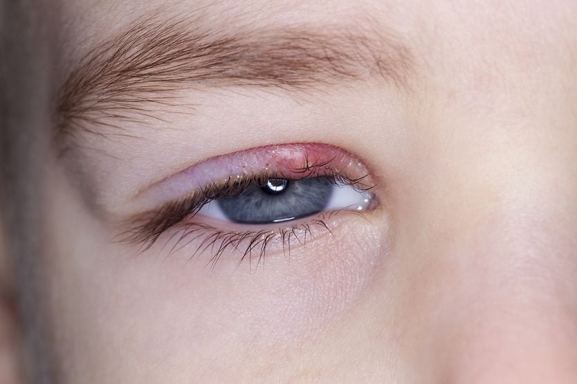 Boy with a stye in his eye
