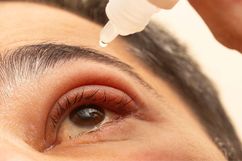A man with a stye puts eye drops into his eye