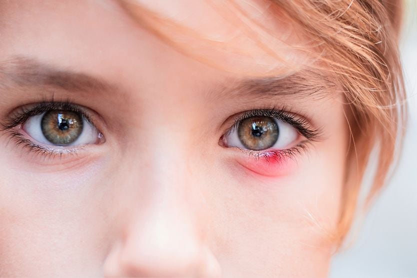 Stye (sty): Causes, symptoms and prevention photo depiction of an eye stye