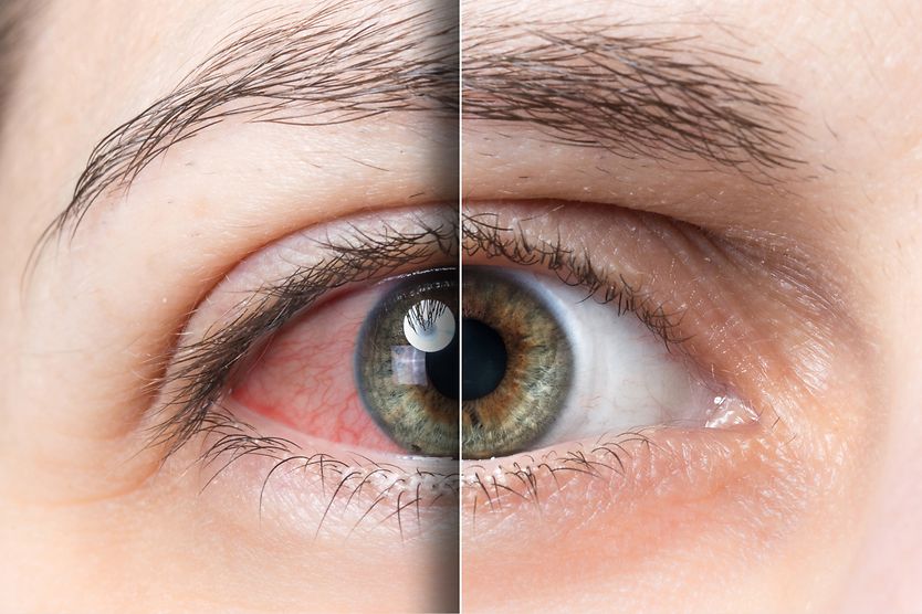 Understanding sunburned eyes (photokeratitis) Red, sunburned eye versus healthy eye.