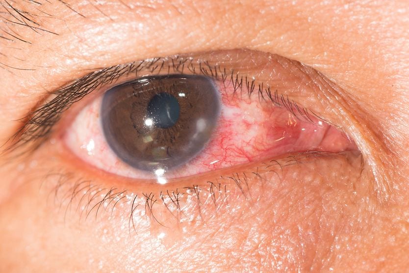 Keratitis: Inflammation of the cornea closeup of an eye with keratitis