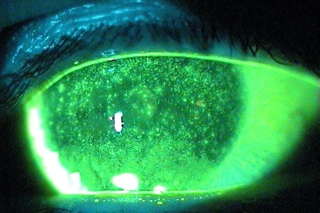 Superficial punctate keratitis: Symptoms, causes and treatment