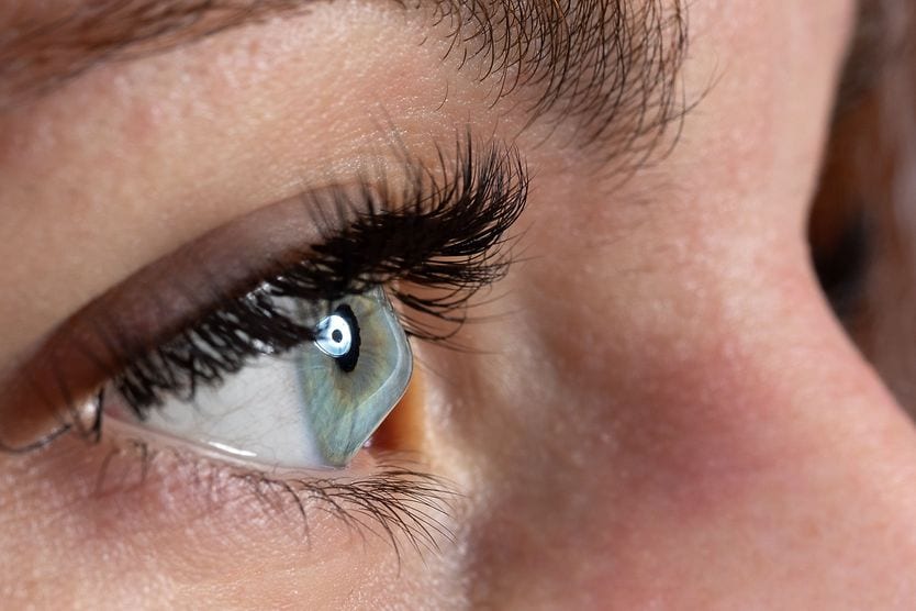 Keratoconus