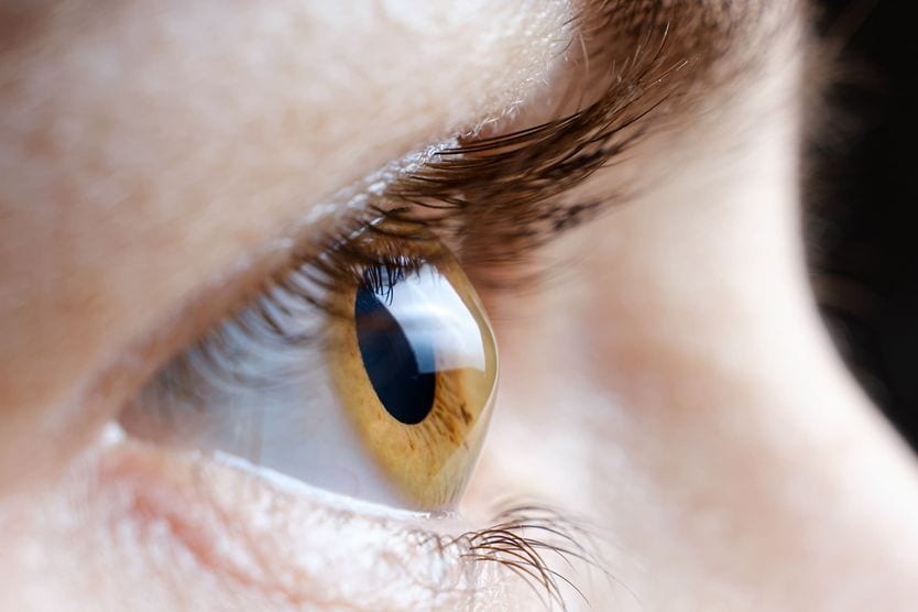 Close-up image of a woman's eye with keratoconus.