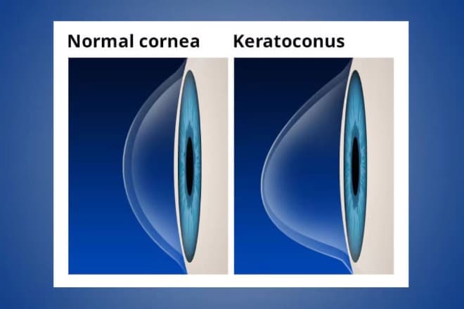Upclose image of and eye with keratoconus