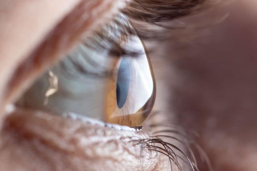 Upclose image of and eye with keratoconus