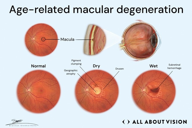 Age-related macular degeneration (AMD)