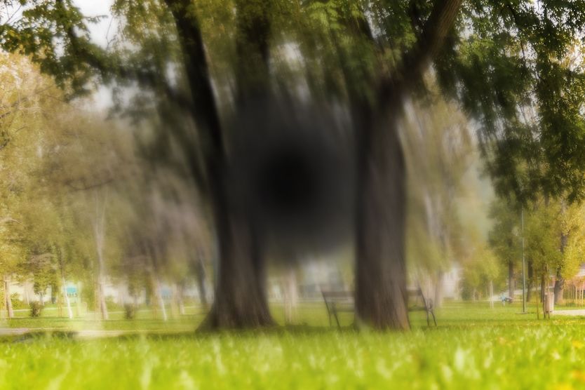 Age-related macular degeneration (AMD)