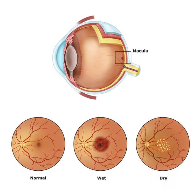Age-related macular degeneration treatment