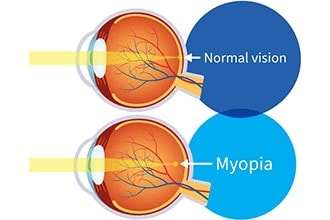 Can too much reading cause myopia in children?