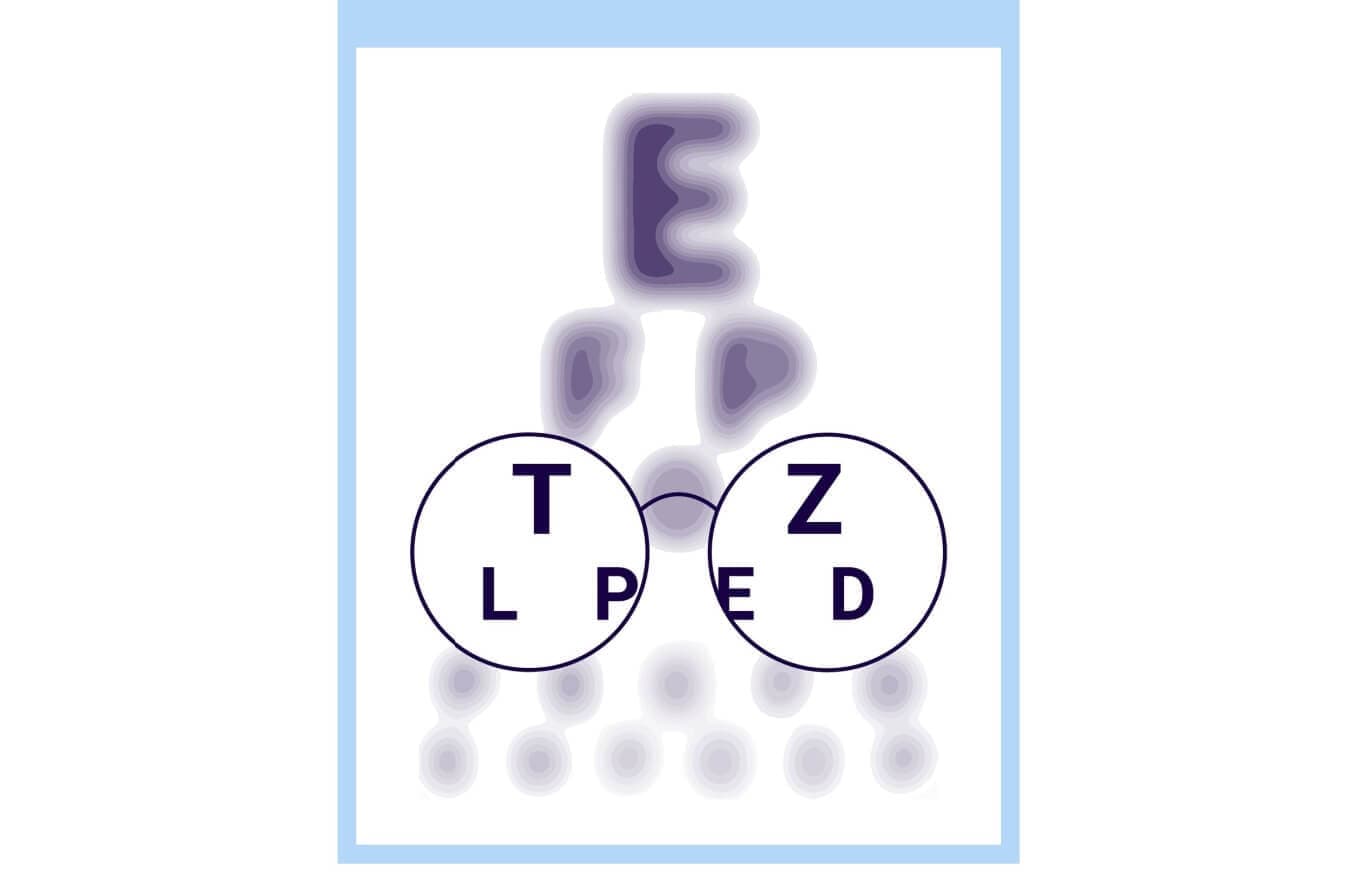 How does a concave lens correct nearsightedness?