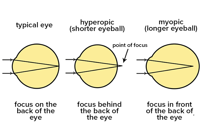 Is nearsightedness due to the eyeball being too long? Is nearsightedness due to the eyeball being too long?