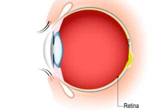 Ocular migraine(s)