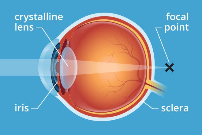 Presbyopia: What causes it and how to treat it