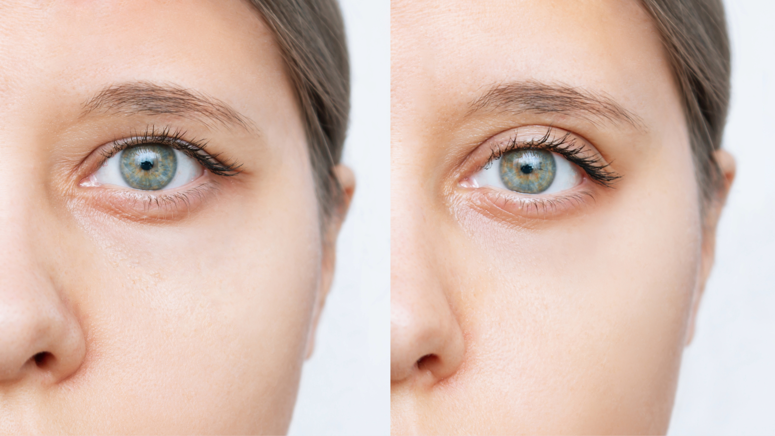 What causes drooping eyelids?