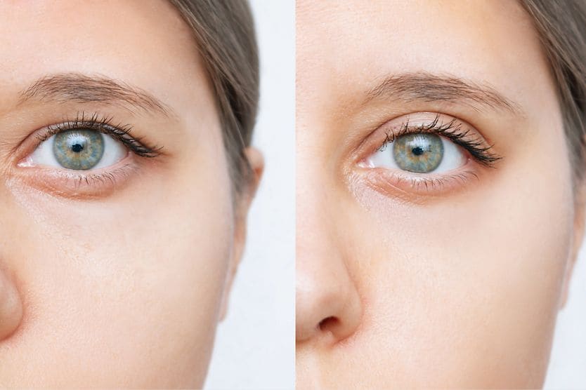 What causes drooping eyelids? before and after side by side image of eyelid surgery