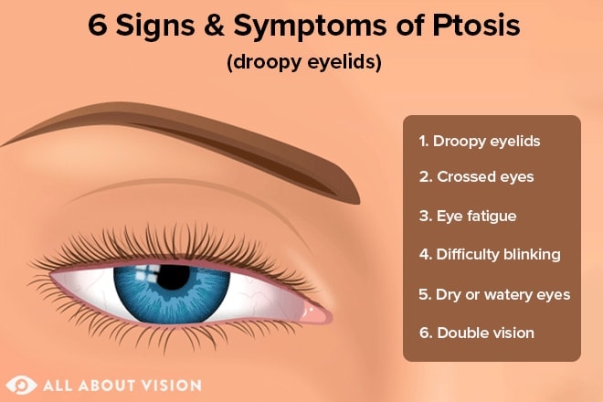 Ptosis: Droopy eyelids