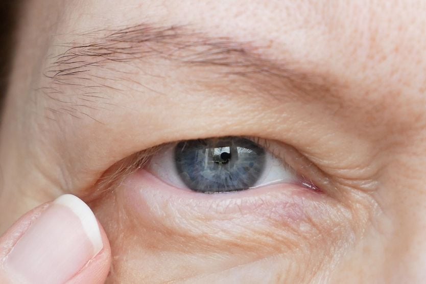 Ptosis: Droopy eyelids