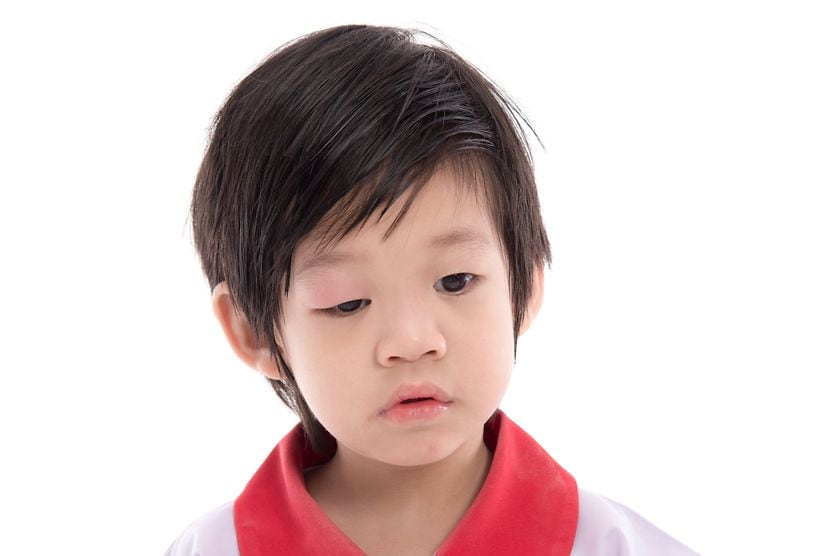 Symptoms of ptosis child showing ptosis symptoms of a droopy eyelid