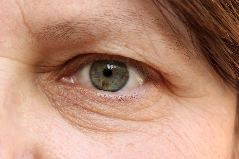 Types of ptosis closeup of a woman with droopy eyelid (ptosis)