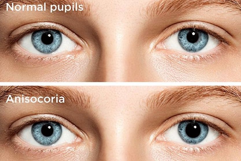 Adie's Tonic Pupil: Causes, Symptoms and Treatment