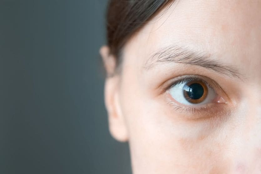 normal pupils vs person with adie's pupil (anisocoria)