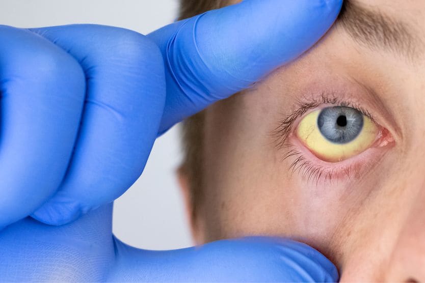 Understanding the impact of anemia on your eyes and vision