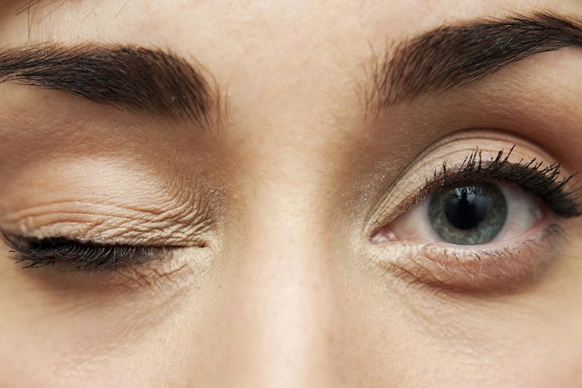 Apraxia of eyelid opening Depiction of person with apraxia of eyelid