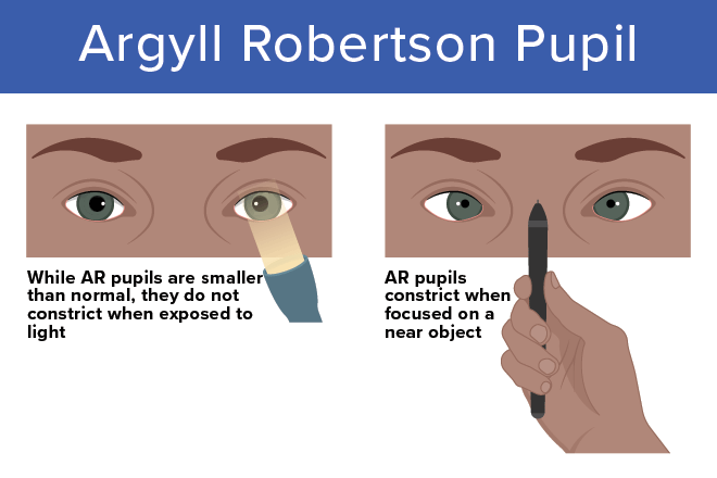 Argyll Robertson pupils: Causes, diagnosis and management