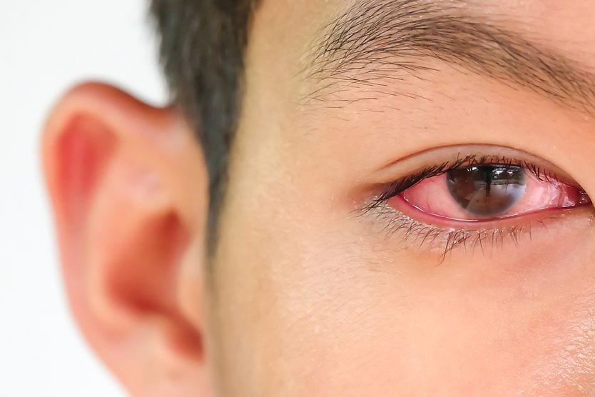 Cogan’s syndrome Red eyes are a symptom of Cogan's Syndrome
