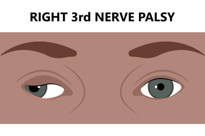 Cranial nerve palsy – CN III, IV, VI & VII palsy Cranial nerve palsy – CN III, IV, VI & VII palsy