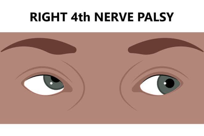 Cranial nerve palsy – CN III, IV, VI & VII palsy Cranial nerve palsy – CN III, IV, VI & VII palsy