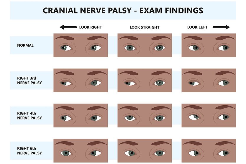 Cranial nerve palsy – CN III, IV, VI & VII palsy Cranial nerve palsy exam findings examples