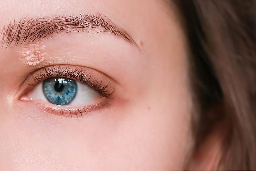 Eyelid psoriasis: Causes, symptoms and treatment girl with psoriasis on upper eyelid