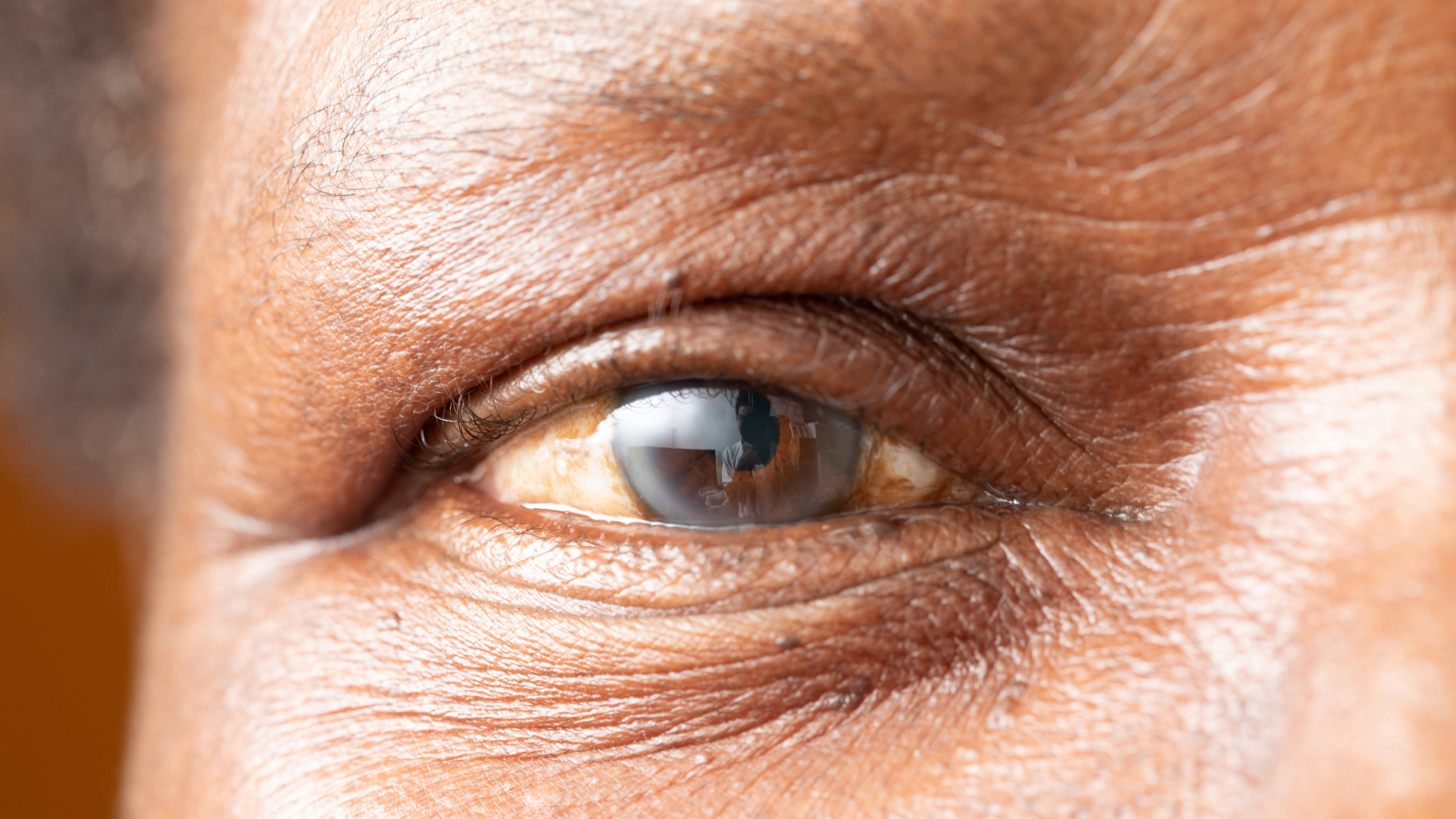Depiction of a person with floppy iris syndrome