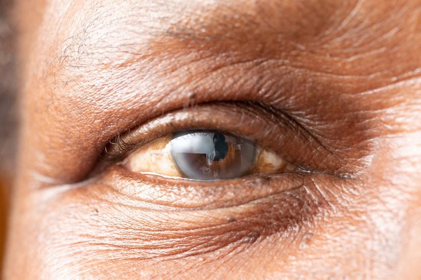 Depiction of a person with floppy iris syndrome