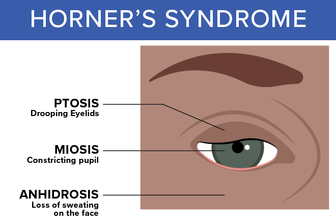 Horner’s syndrome Horner’s syndrome