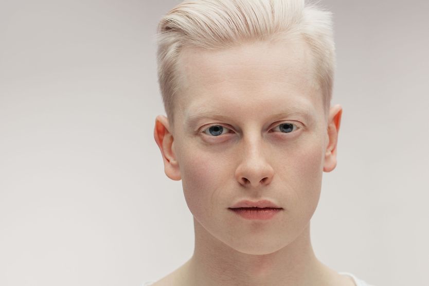 man with albinism