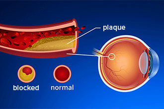 What your eye doctor can tell about your heart health