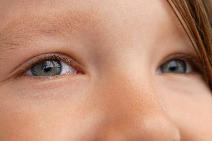 A person with hypertelorism (widely spaced eyes)
