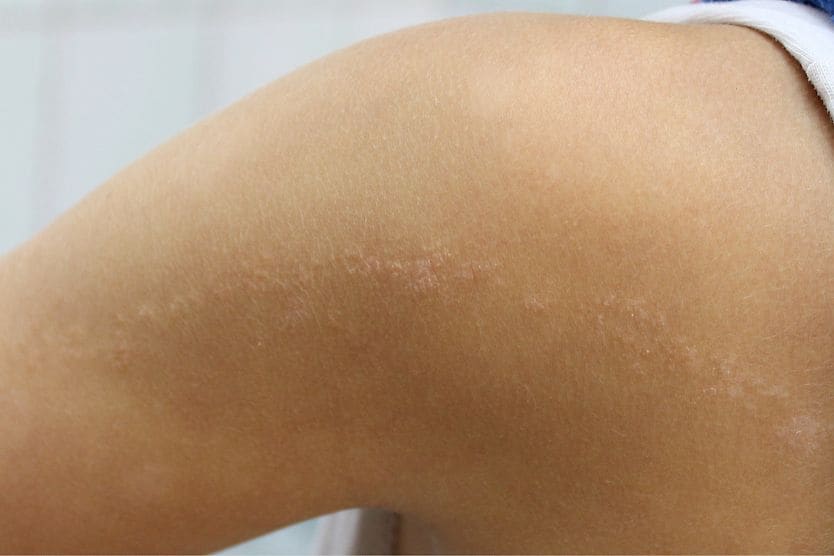 A visual case of a linear epidermal nevus in a child.