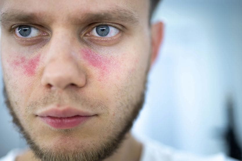 Five ways lupus can affect eyes and vision health Depiction of systemic lupus erythematosus and its effect around the eyes